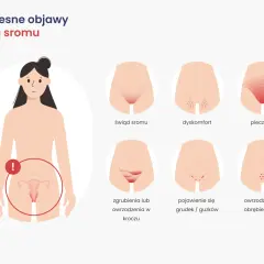 Ilustracja przedstawia wczesne objawy raka sromu: świąd, pieczenie, dyskomfort, owrzodzenia i grudki.