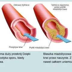 Porównanie zdrowej tętnicy z tą zwężoną przez płytki miażdżycowe. Układ krwionośny jest kluczowy dla zdrowia.