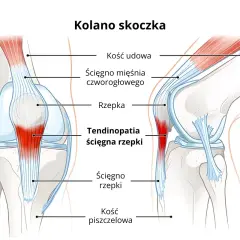 Ilustracja anatomiczna kolana z zaznaczoną rzepką i ścięgnem, z obszarem zapalenia.