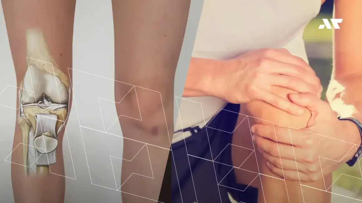 Anatomia kolana po lewej, a po prawej osoba trzymająca się za bolące kolano.