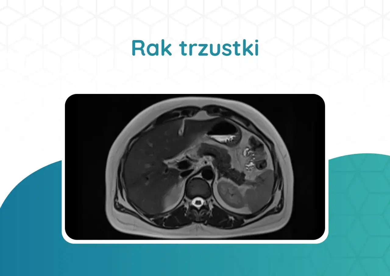 Przekrój rezonansu magnetycznego jamy brzusznej, ukazujący trzustkę. Obraz pomocny w diagnostyce, jakie badania na trzustkę są potrzebne.