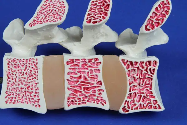 Model kręgosłupa pokazuje, jak wygląda osteopenia: kości są mniej gęste, z większymi pustymi przestrzeniami wewnątrz.