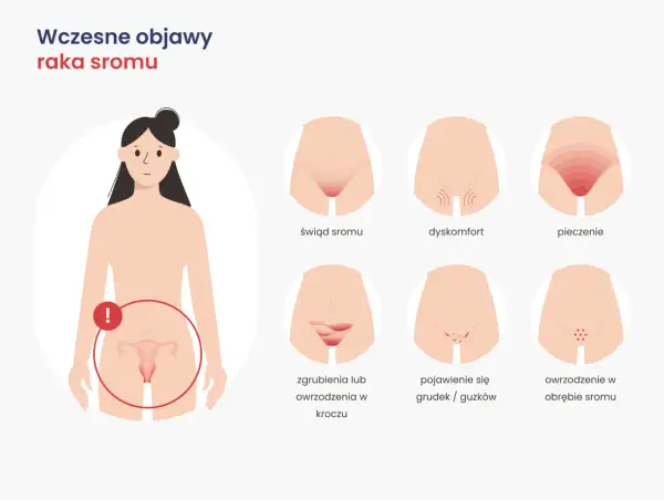 Ilustracja przedstawia wczesne objawy raka sromu: świąd, pieczenie, dyskomfort, owrzodzenia i grudki.