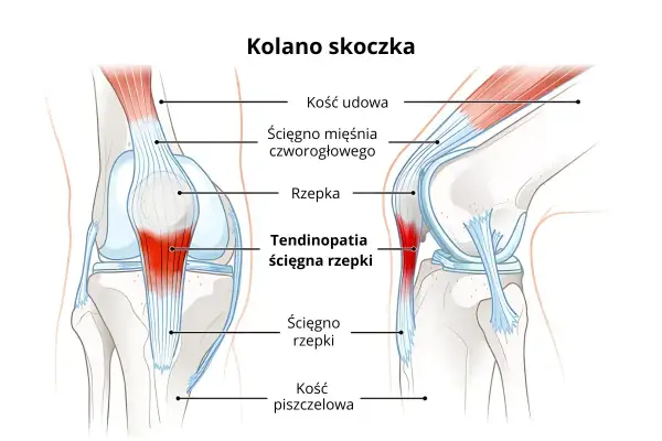 Ilustracja anatomiczna kolana z zaznaczoną rzepką i ścięgnem, z obszarem zapalenia.