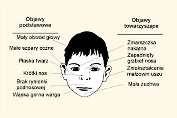 Ilustracja twarzy dziecka z zaznaczonymi cechami zespołu FAS: mały obwód głowy, płaska twarz, krótki nos, wąska górna warga.